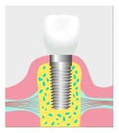 dental-implants1
